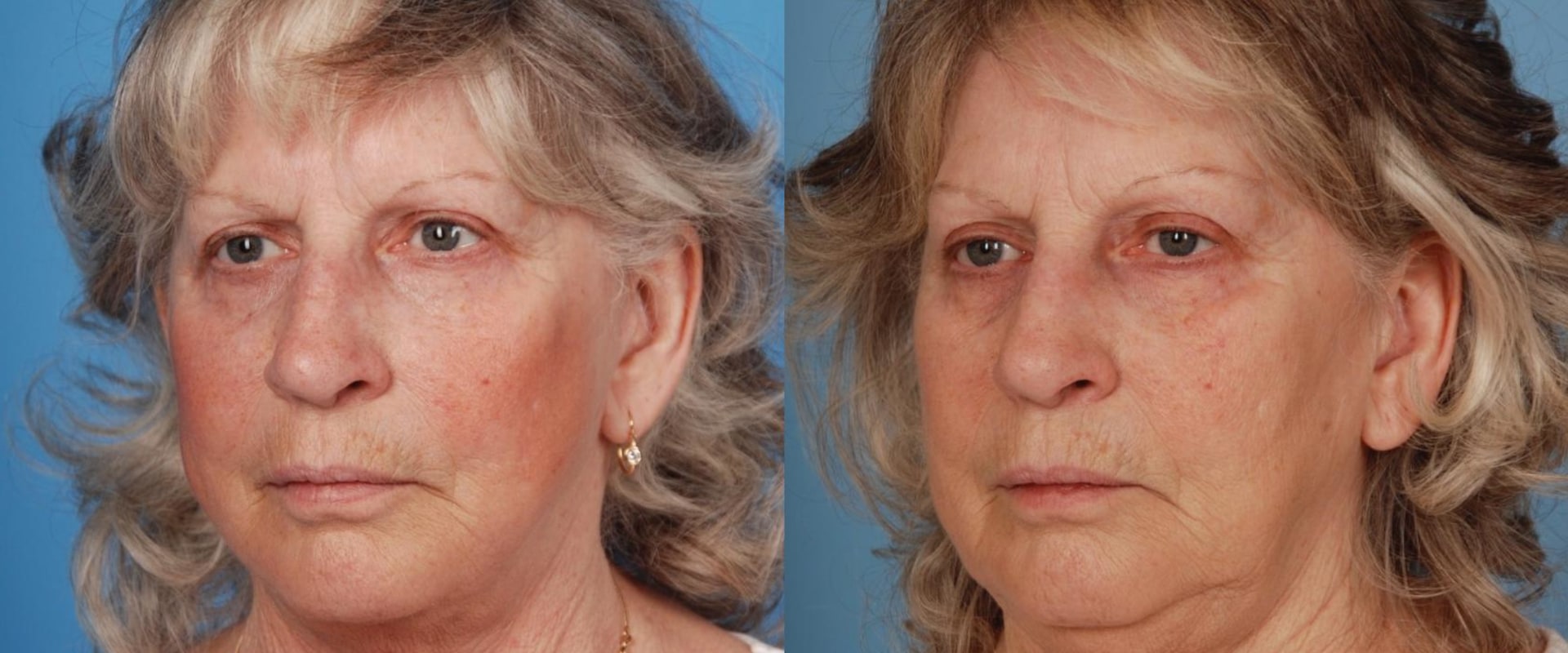 How many face lifts can you get in a lifetime?