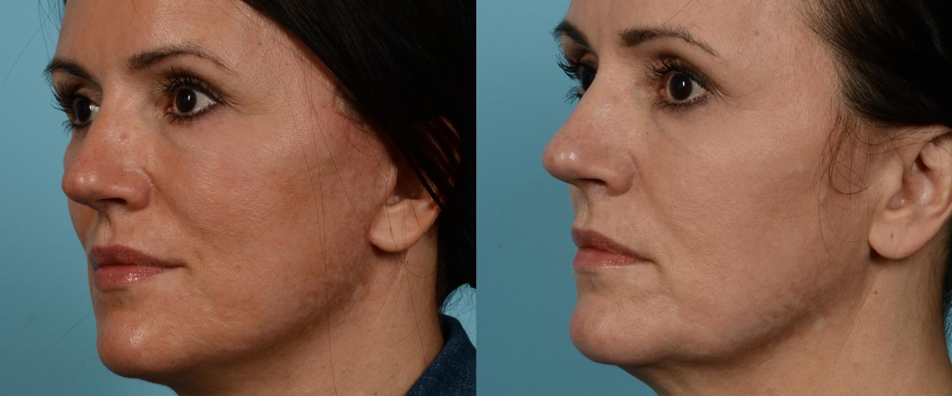 What is the best age for a mini face lift?