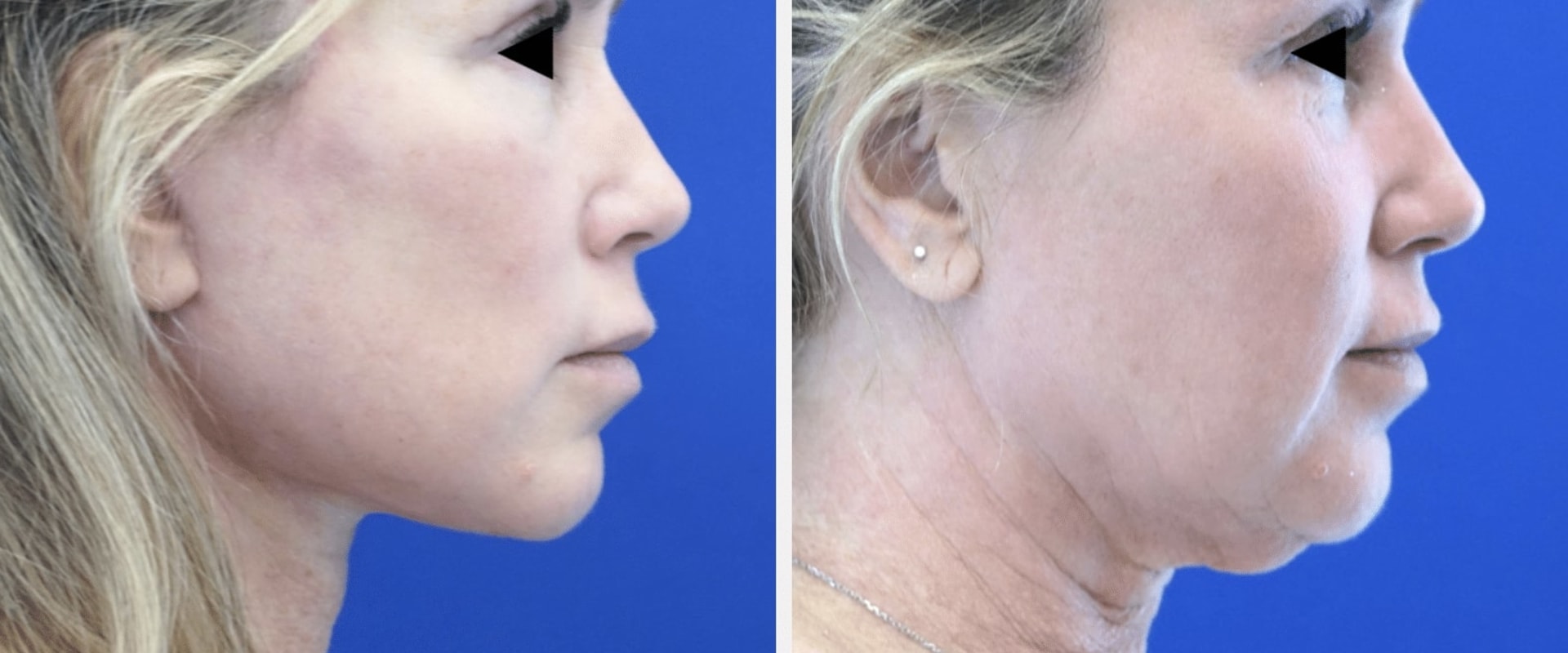 What is the best age for a deep plane face lift?