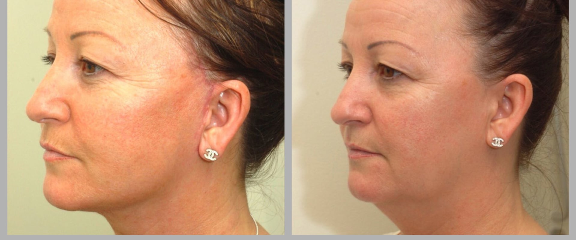 Facelift for Facial Rejuvenation: Achieving a Youthful Look in Glasgow