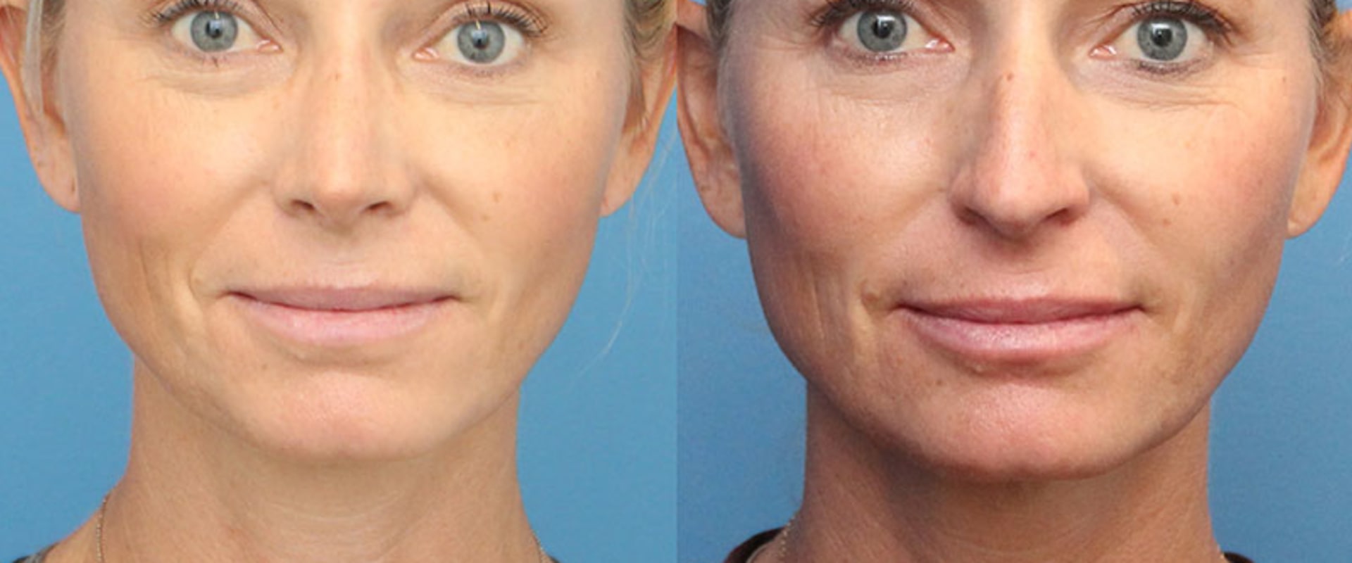 Brow Lift for a More Youthful Appearance