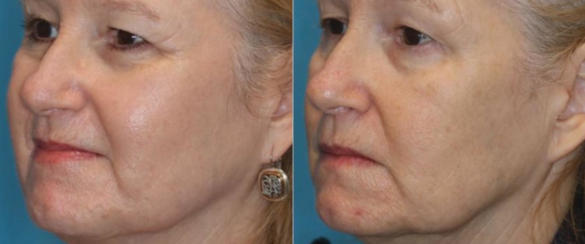 The Benefits of Laser Skin Resurfacing for Fine Lines and Wrinkles