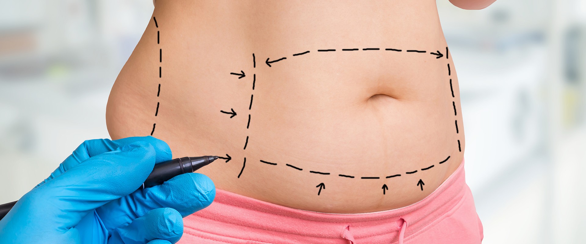 Tummy Tuck for a Flatter Stomach: Achieve Your Dream Body