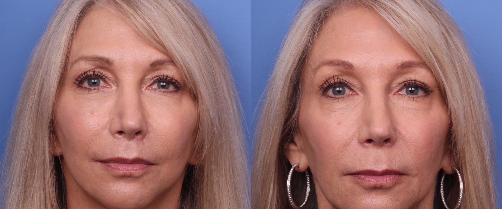 How many years younger does a facelift make you look?