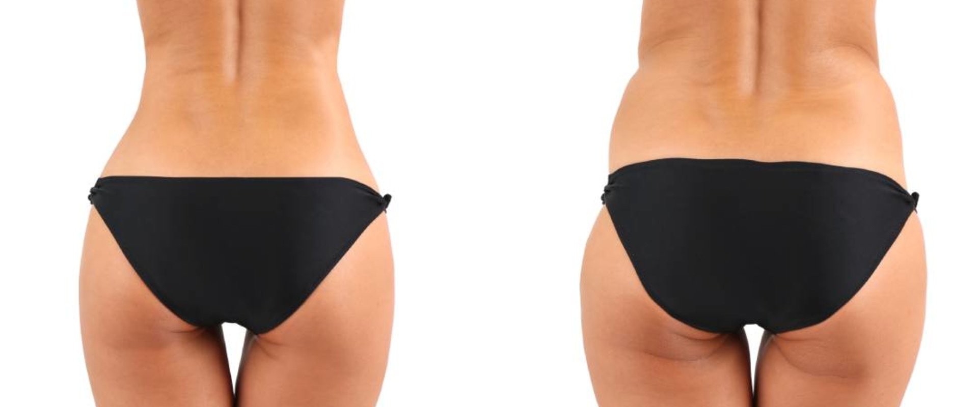 Liposuction for Body Contouring: Transform Your Appearance in Glasgow