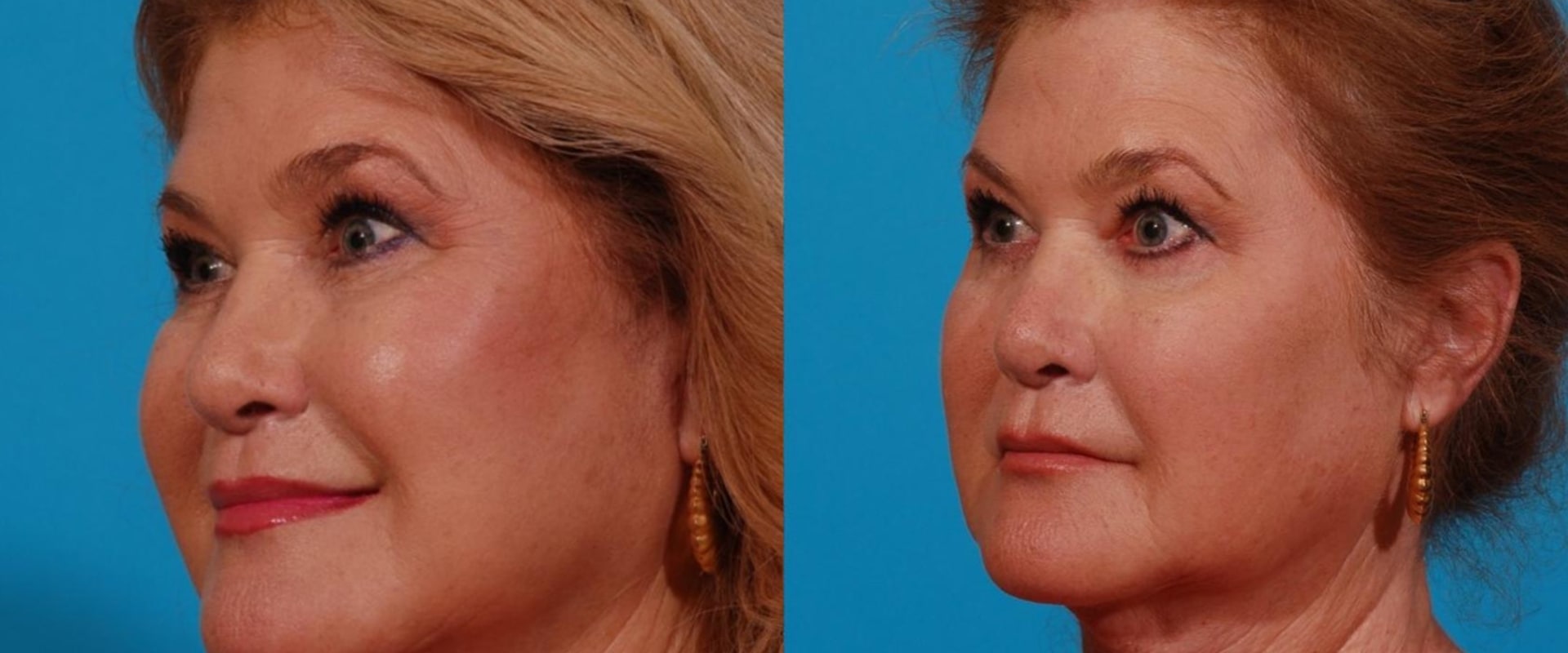 Who is a good candidate for deep plane facelift?