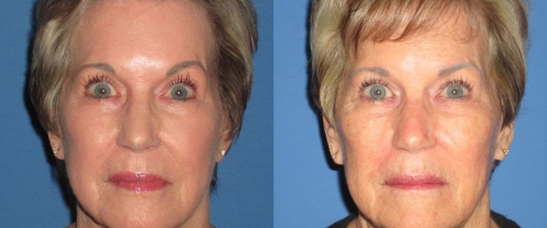 What is the oldest age to get a facelift?