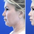 What is the best age for a deep plane face lift?