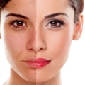 The Power of Glycolic Acid Peels: Exfoliation and Brightening for Glowing Skin in Glasgow