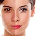 TCA Peels for Deeper Exfoliation and Anti-Aging Benefits in Glasgow