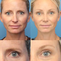 Brow Lift for a More Youthful Appearance