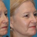 The Benefits of Laser Skin Resurfacing for Fine Lines and Wrinkles