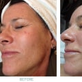 Combining Chemical Peels and Microdermabrasion: The Perfect Pair for Beautiful Skin