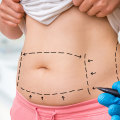 Tummy Tuck for a Flatter Stomach: Achieve Your Dream Body