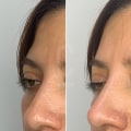 A Complete Guide to Fillers for Adding Volume and Contouring Features