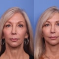 How many years younger does a facelift make you look?