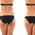 Liposuction for Body Contouring: Transform Your Appearance in Glasgow