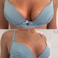 Breast Augmentation: Enhance Your Appearance with Fuller Breasts