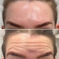 The Benefits of Botox for Wrinkle Reduction