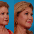 Who is a good candidate for deep plane facelift?