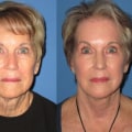 What is the oldest age to get a facelift?