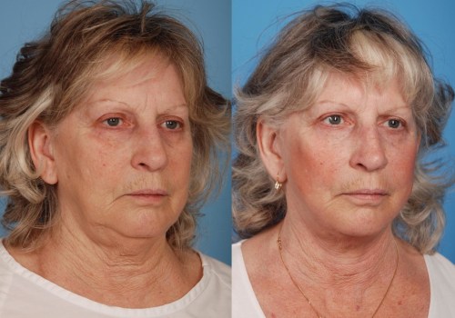 How many face lifts can you get in a lifetime?