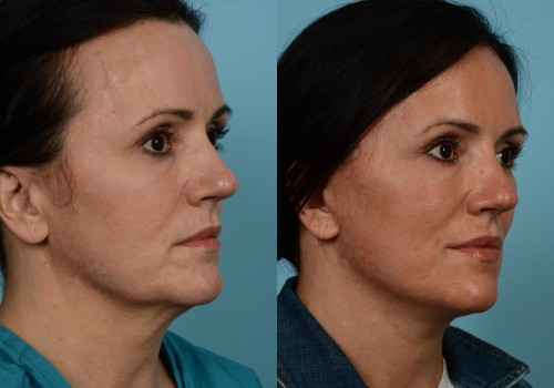 What is the best age for a mini face lift?