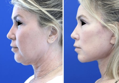 What is the best age for a deep plane face lift?