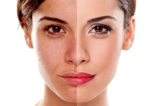 The Power of Glycolic Acid Peels: Exfoliation and Brightening for Glowing Skin in Glasgow