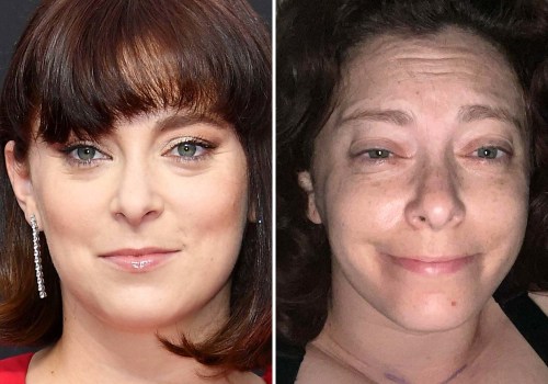 Are most people happy with their facelifts?