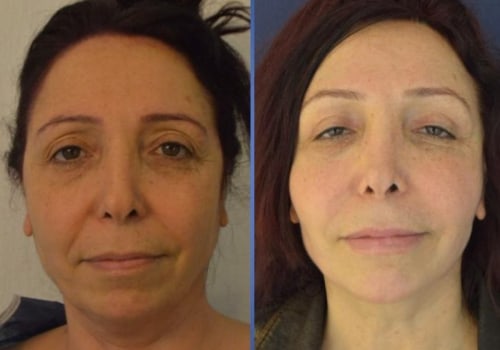 How much is a facelift in europe?