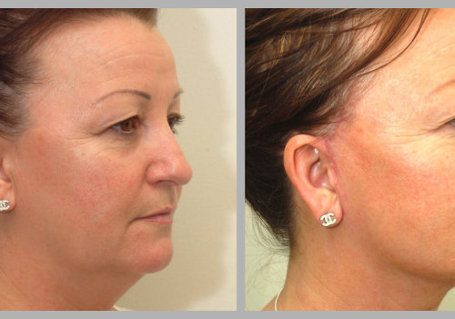 Facelift for Facial Rejuvenation: Achieving a Youthful Look in Glasgow