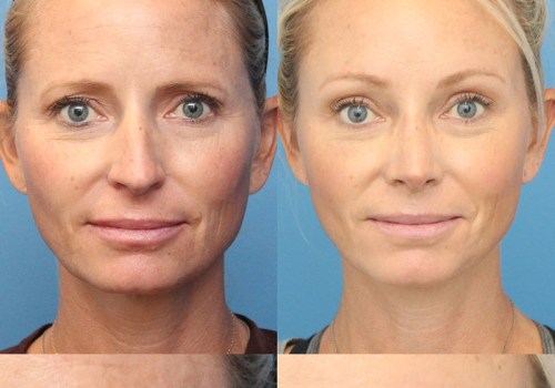 Brow Lift for a More Youthful Appearance