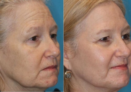 The Benefits of Laser Skin Resurfacing for Fine Lines and Wrinkles