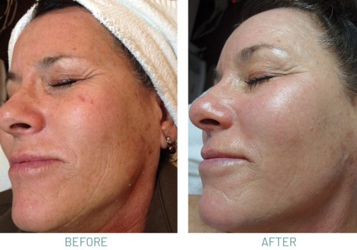 Combining Chemical Peels and Microdermabrasion: The Perfect Pair for Beautiful Skin