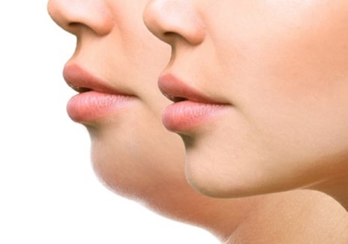 Kybella: The Non-Invasive Solution for Reducing Double Chin Fat