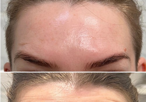 Botox for Reducing Fine Lines and Wrinkles: The Ultimate Guide