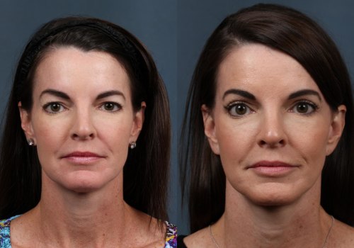 What age should i have a face lift?