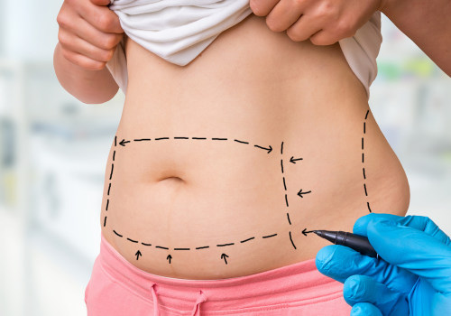 Tummy Tuck for a Flatter Stomach: Achieve Your Dream Body