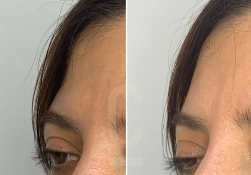 A Complete Guide to Fillers for Adding Volume and Contouring Features