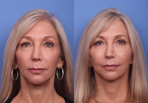 How many years younger does a facelift make you look?