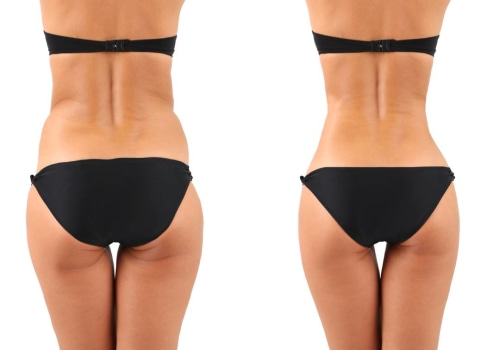 Liposuction for Body Contouring: Transform Your Appearance in Glasgow