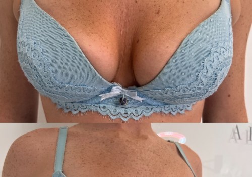 Breast Augmentation: Enhance Your Appearance with Fuller Breasts