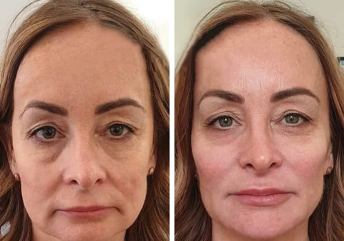 Combining Laser Skin Treatments for Overall Skin Rejuvenation: A Comprehensive Guide for People in Glasgow