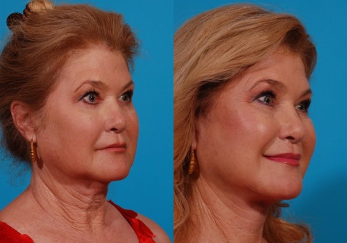 Who is a good candidate for deep plane facelift?