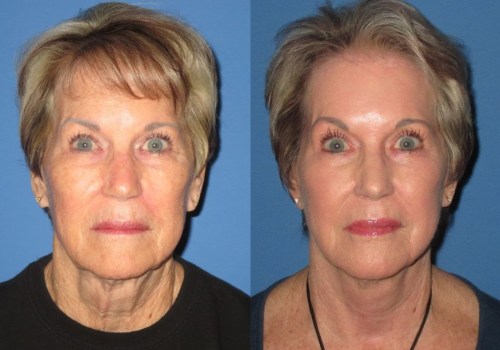 What is the oldest age to get a facelift?